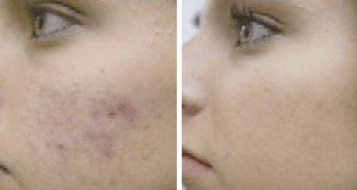 profacial antes y después acne Aqua Peeling, Ion Lifting, radiofrecuencia y Ultrasonidos. belium medical distribuidor españa. Limpieza facial profunda, rejuvenecimiento, antiarrugas, producción de colágeno
