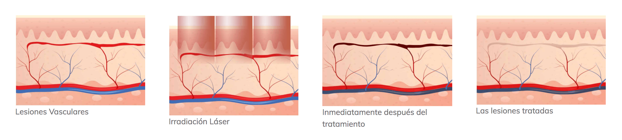 v-laser lesiones vasculares, pigmentarias y rejuvenecimiento. Belium Medical distribuidor oficial españa