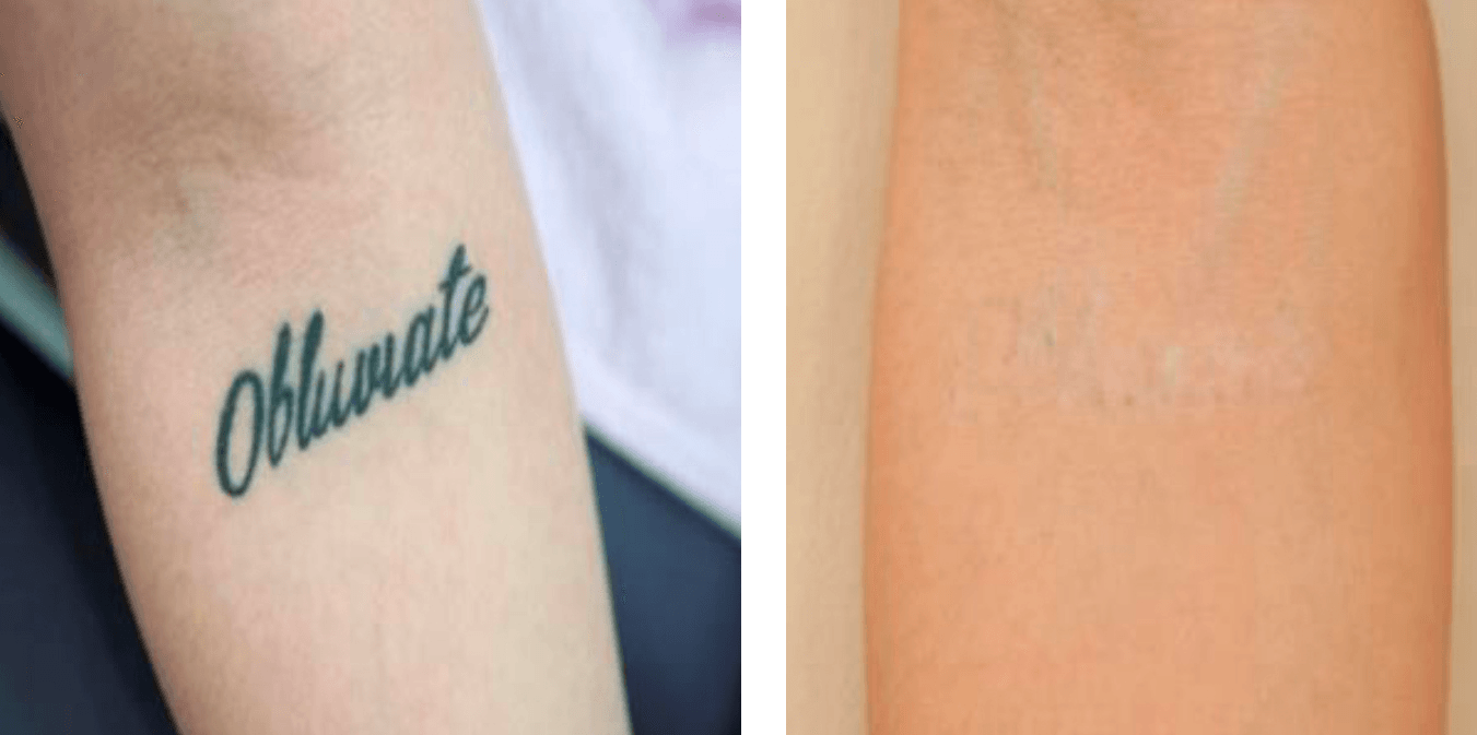 antes y después picocare FDA laser picosegundo para eliminación de tatuajes y lesiones pigmentadas. Belium medical distribuidor oficial españa