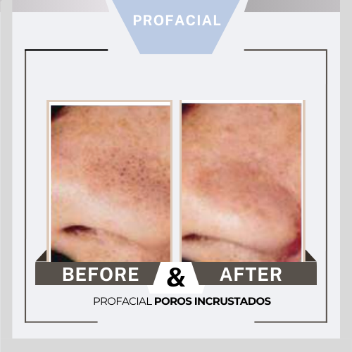 Profacial antes después 4