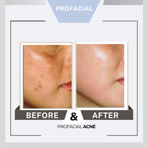 Profacial antes después 3