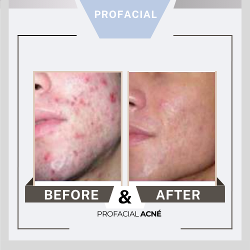Profacial antes después 2