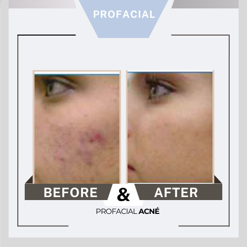 Profacial antes después