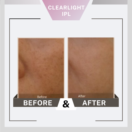 Before&After Clearlight1 clearlight equipo, luz, pulso, intenso, IPL, filtros, belium, medical, aparatología, piel, rejuvenecimiento