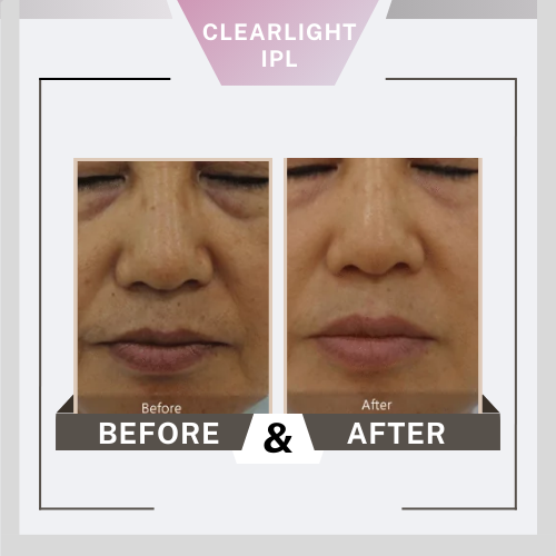 Before&After Clearlight2 clearlight equipo, luz, pulso, intenso, IPL, filtros, belium, medical, aparatología, piel, rejuvenecimiento