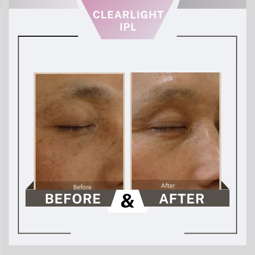 Before&After Clearlight3 clearlight equipo, luz, pulso, intenso, IPL, filtros, belium, medical, aparatología, piel, rejuvenecimiento
