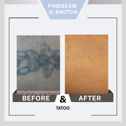 Before&After Finebeam Q1