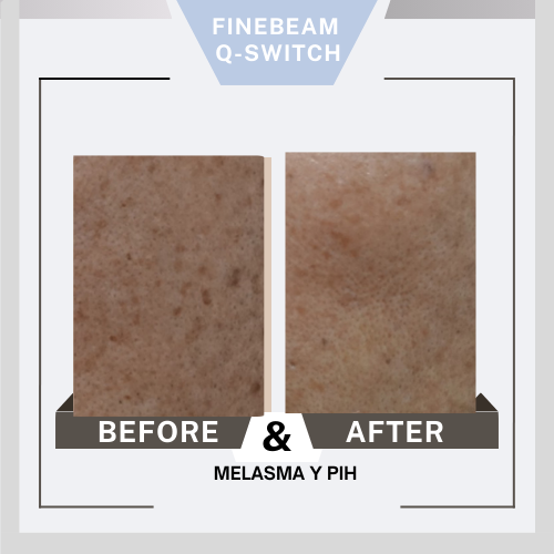 Before&After Finebeam Q2