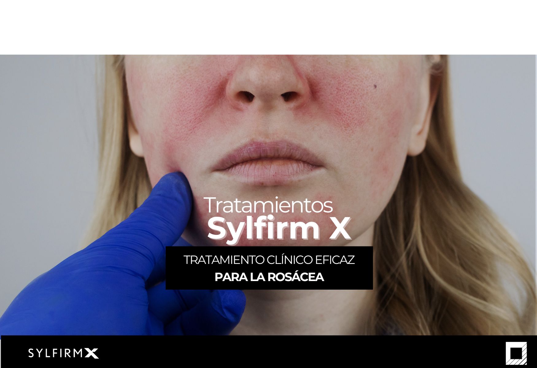 Sylfirm X para rosácea y enrojecimiento: una solución efectiva y segura