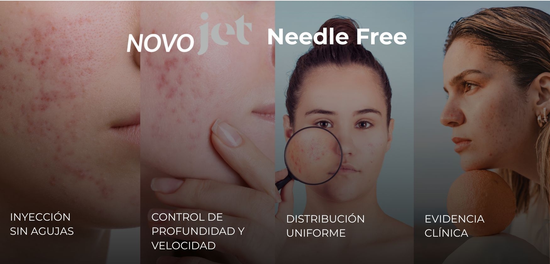 Tratamiento de Cicatrices de Acné con NovoJet (inyección sin agujas)