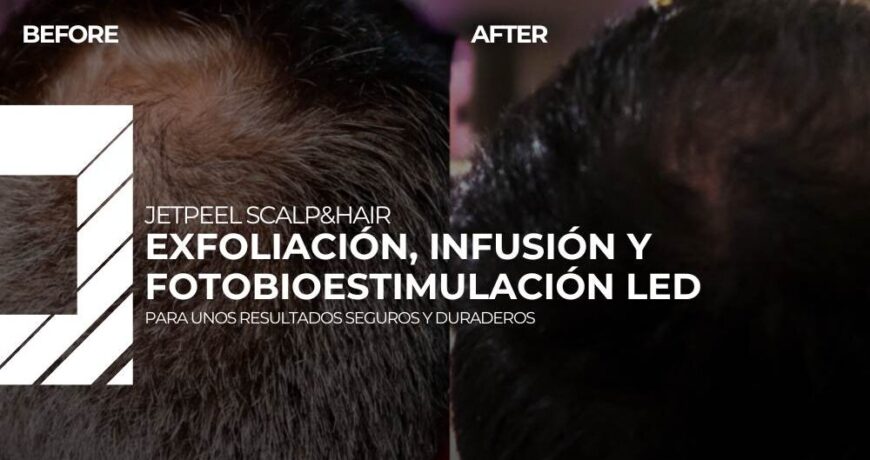 JetPeel capilar: fases del tratamiento, beneficios y resultados