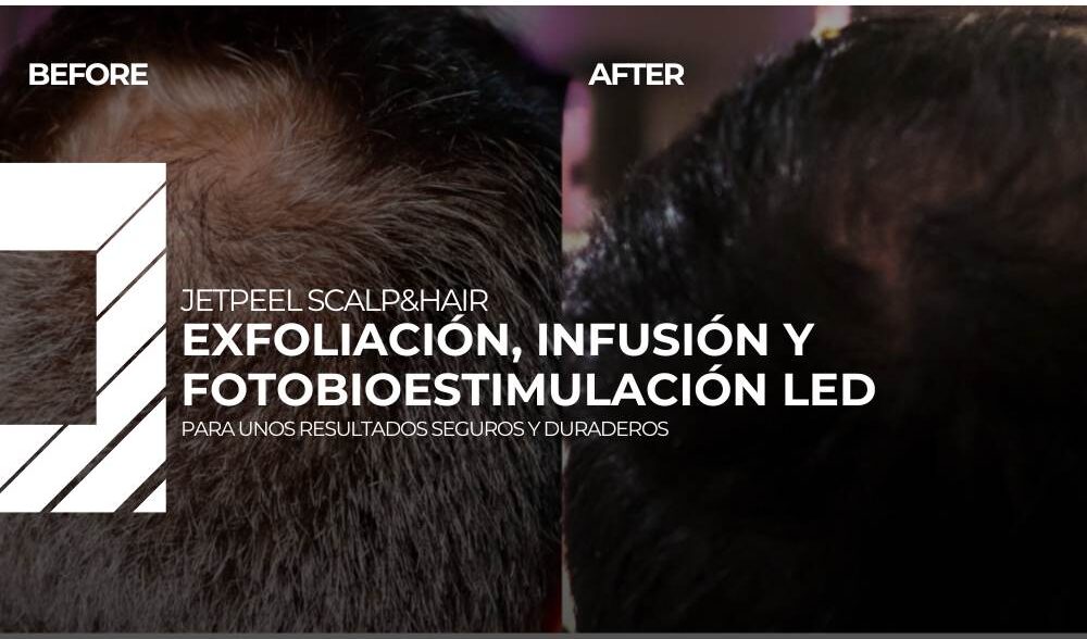 JetPeel capilar: fases del tratamiento, beneficios y resultados