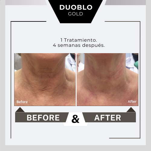 Before&after Duoblo Gold