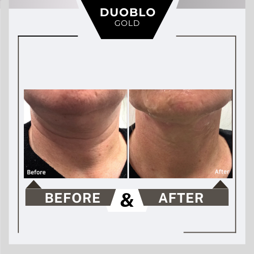 Before&after Duoblo Gold