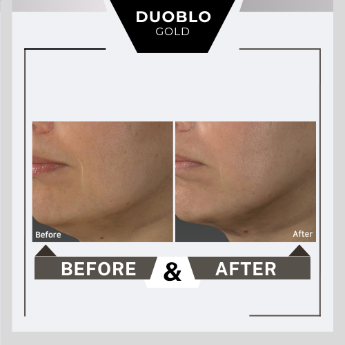 Before&after Duoblo Gold