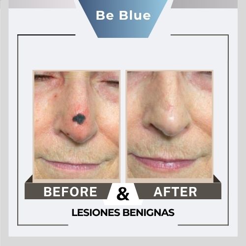 Be blue Before&After