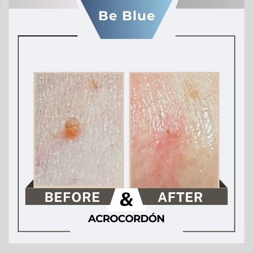 Be blue Before&After