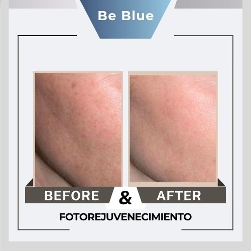 Be blue Before&After