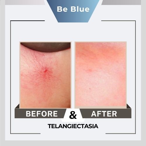 Be blue Before&After