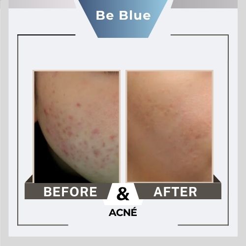 Be blue Before&After