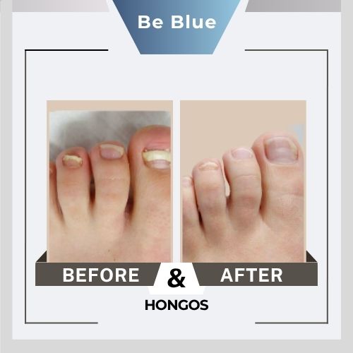 Be blue Before&After