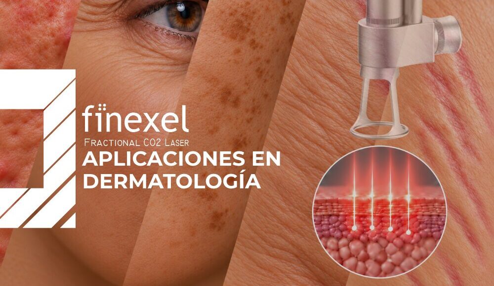 Finexel CO₂ fraccionado: aplicaciones en dermatología